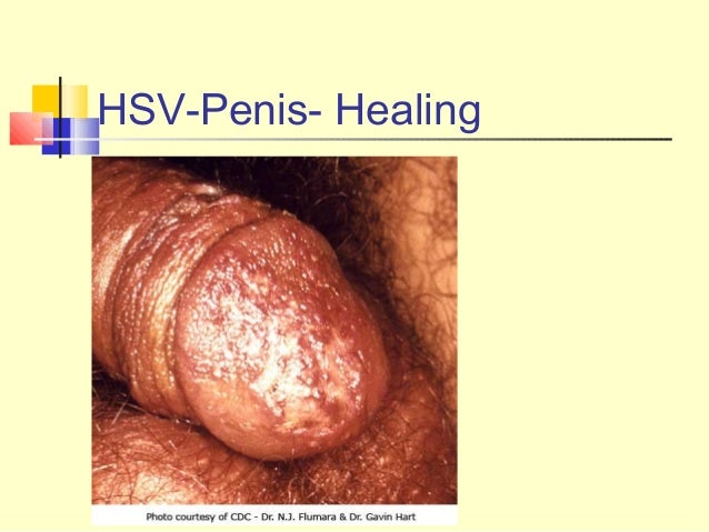 Herpes On Penis Head